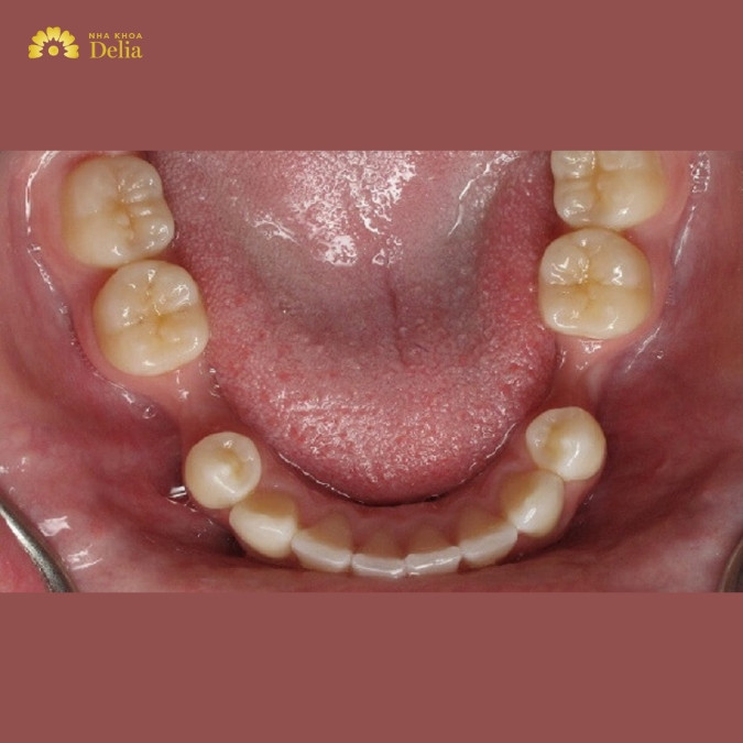 Răng hàm bị mất nguyên nhân do đâu? 