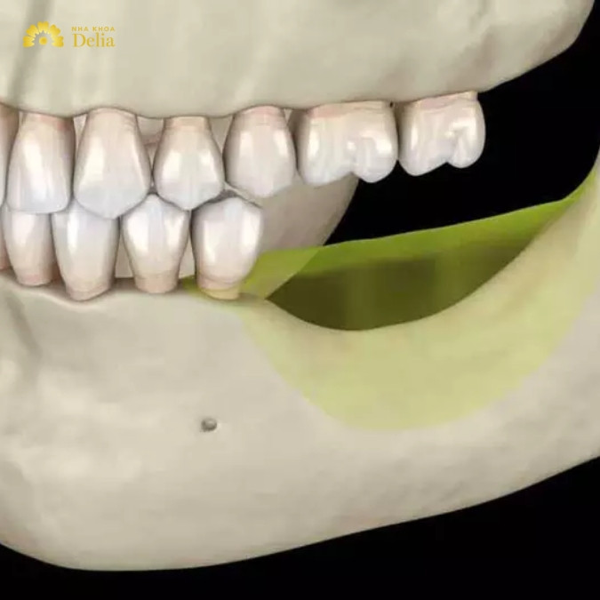 Mất răng hàm có thể gây ra những ảnh hưởng gì? 