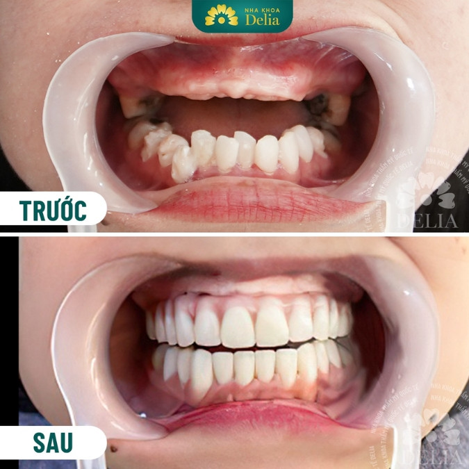 Mất răng hàm nên khắc phục bằng phương pháp nào hiệu quả? 
