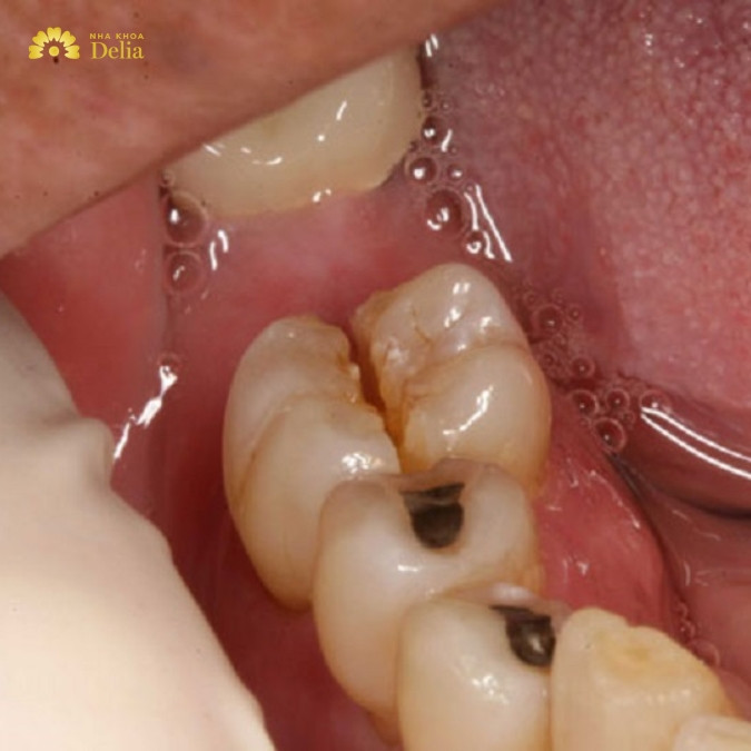 Răng hàm bị mất nguyên nhân do đâu? 
