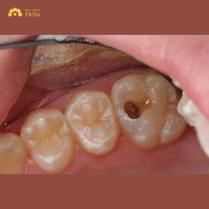 Răng hàm bị mất nguyên nhân do đâu? 
