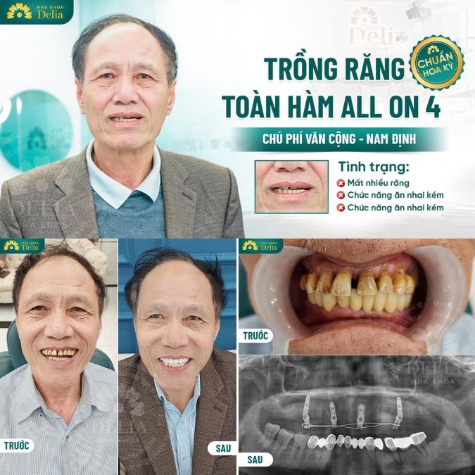 Mất răng lâu năm có trồng được không?