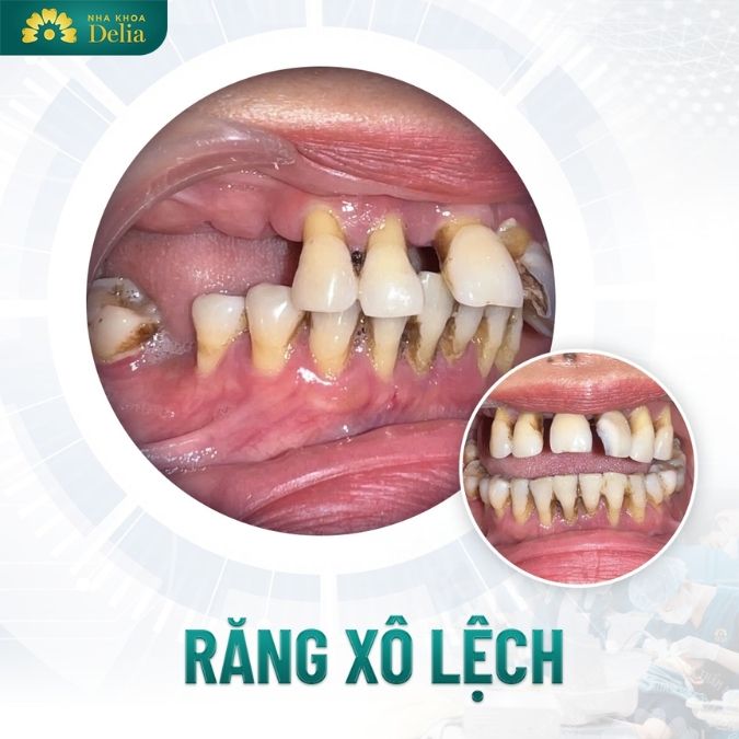 Mất răng lâu năm có thể gây ra những hậu quả nghiêm trọng gì?