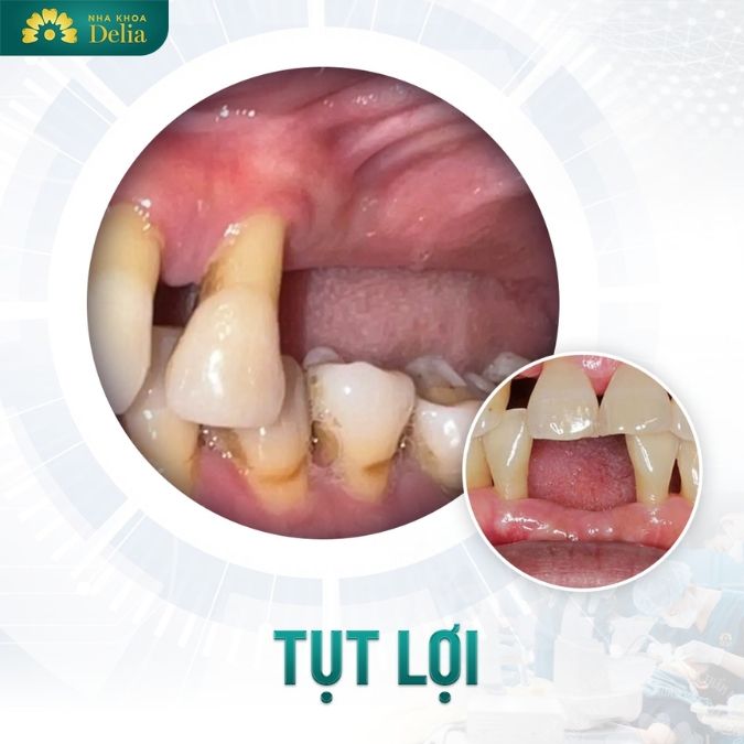 Mất răng lâu năm có thể gây ra những hậu quả nghiêm trọng gì?