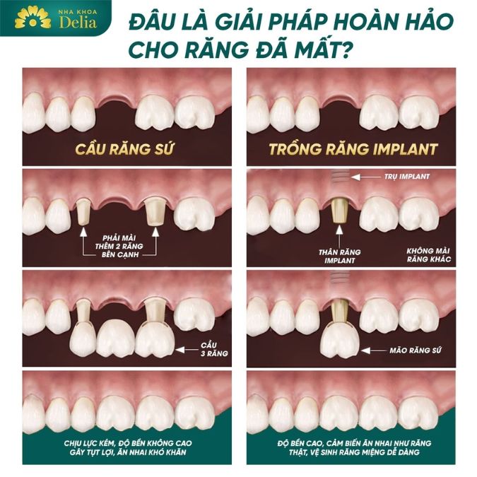 Mất răng lâu năm nên điều trị hiệu quả bằng phương pháp trồng răng nào?