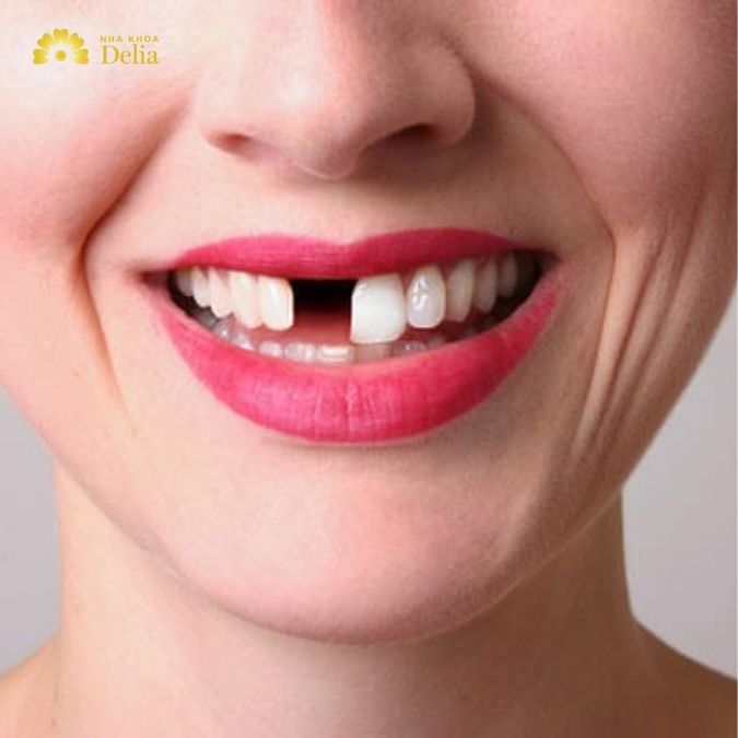 Nhổ răng cửa bao lâu thì trồng lại được?