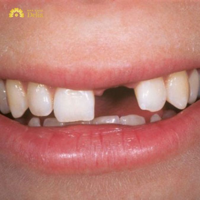 Nhổ răng cửa xong không trồng lại có sao không?