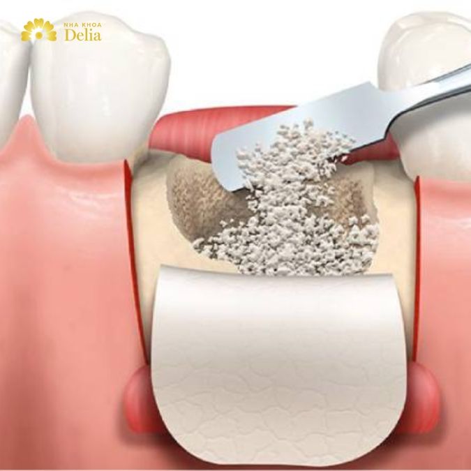 Nhổ răng cửa xong không trồng lại có sao không?