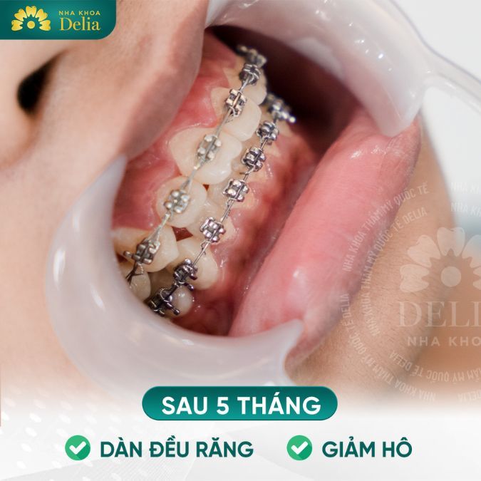 Niềng răng hở kẽ