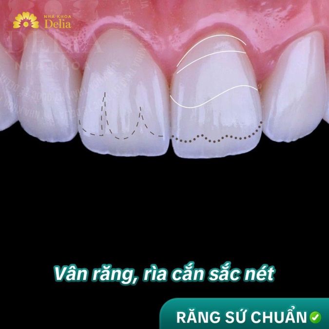 Phục hình răng sứ trên Implant có ưu điểm gì vượt trội?