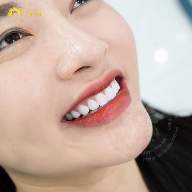 Nên sử dụng dòng sứ nào để phục hình trên Implant?