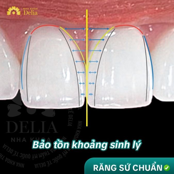 Phục hình răng sứ trên Implant có ưu điểm gì vượt trội?