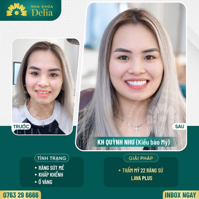 Customer Quynh Nhu - Covered 22 Lava Plus porcelain teeth