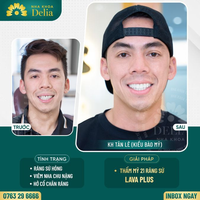 Customer Tan Le - Covered 21 Lava Plus porcelain teeth