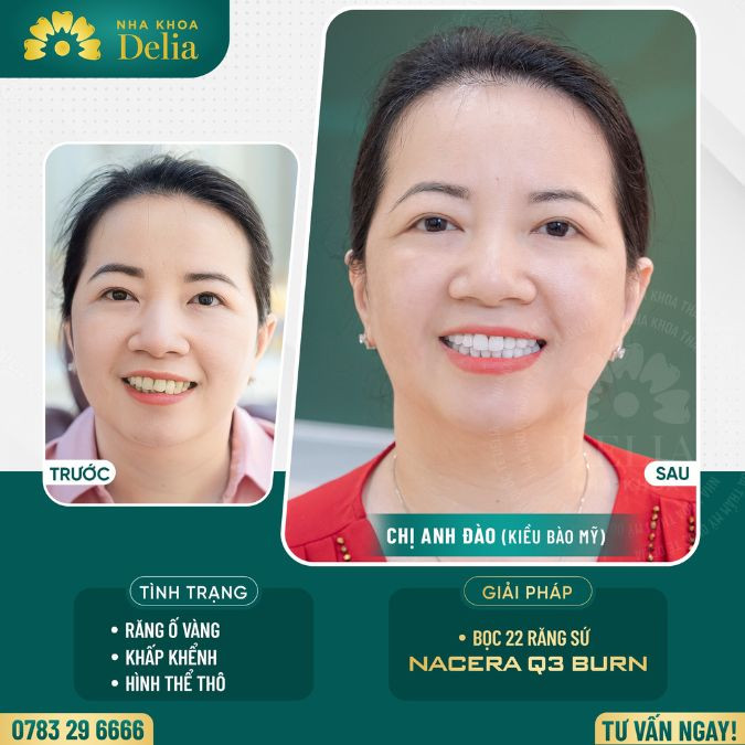 Porcelain crowns front teeth before and after of Anh Dao
