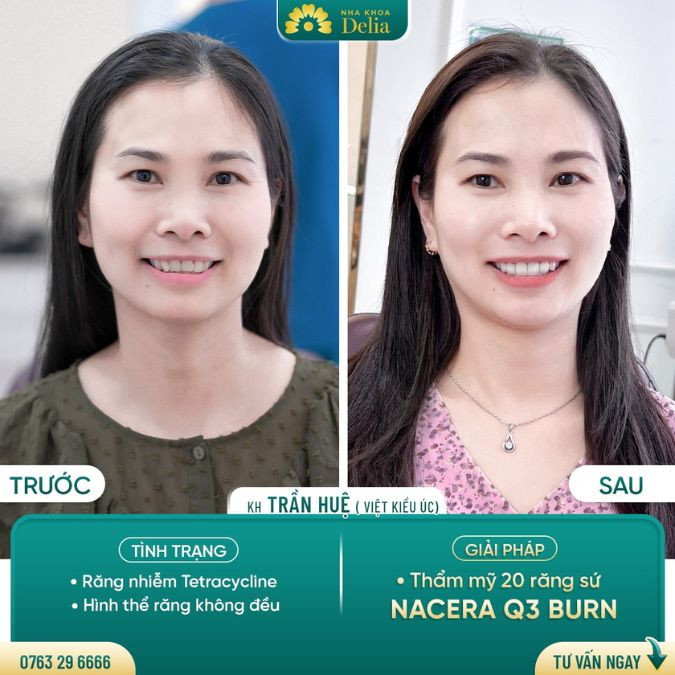 Image dental crowns before and after of customer Tran Hue