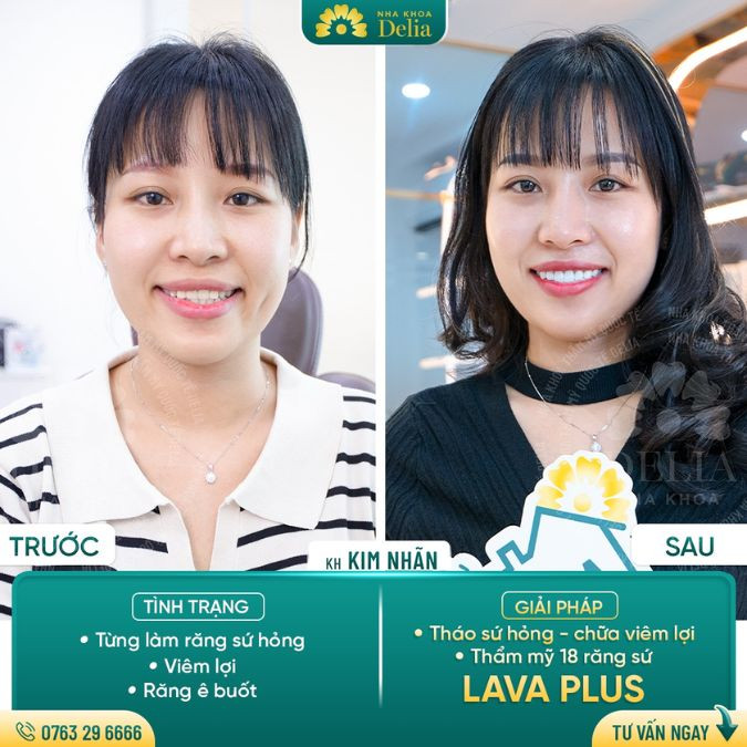 Dental crowns before and after pictures of customer Kim Ngan