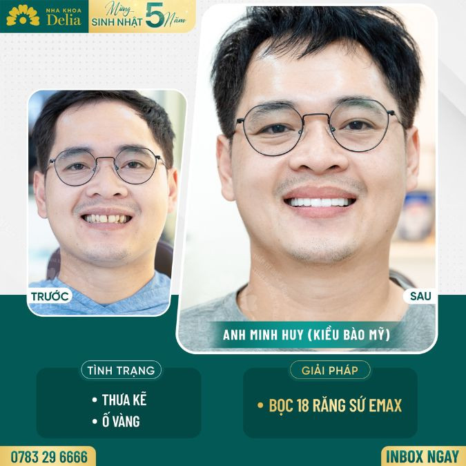 Customer Minh Huy got porcelain teeth at Delia dental clinic