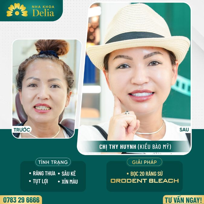 Customer Thy Huynh got porcelain teeth at Delia dental clinic