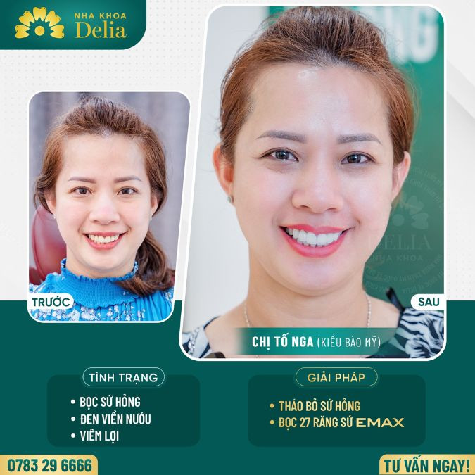 Customer To Nga got porcelain teeth at Delia dental clinic