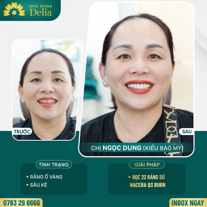 Customer Ngoc Dung got porcelain teeth at Delia dental clinic