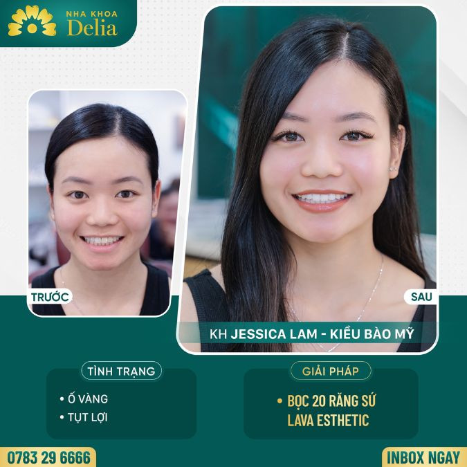 Customer Jessica Lam got porcelain teeth at Delia dental clinic