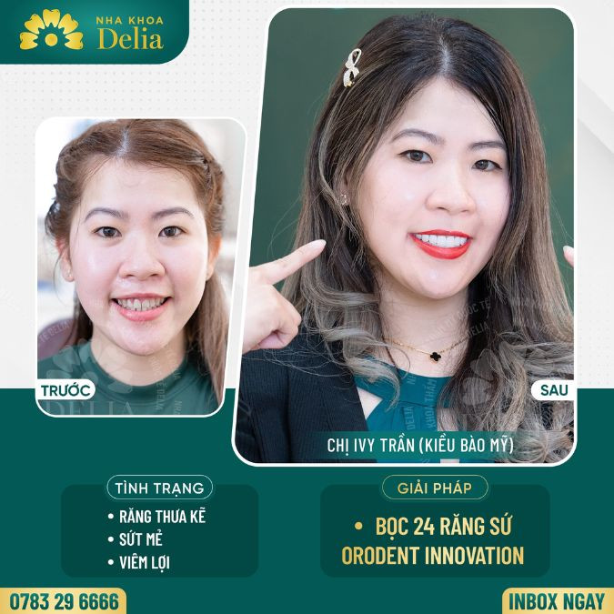 Customer Ivy Tran got porcelain teeth at Delia dental clinic