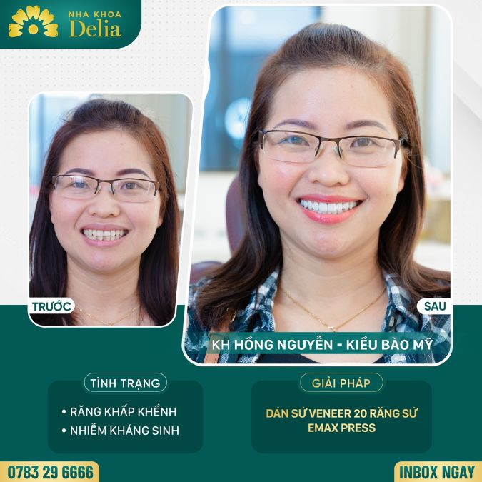 Customer Hong Nguyen got porcelain teeth at Delia dental clinic