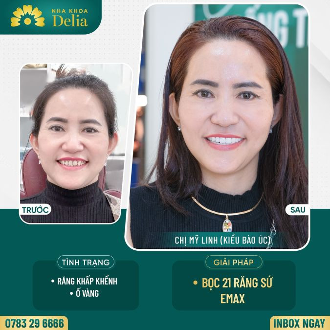 Customer My Linh got porcelain teeth at Delia dental clinic