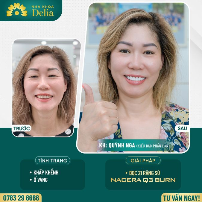 Customer Quynh Nga got porcelain teeth at Delia dental clinic