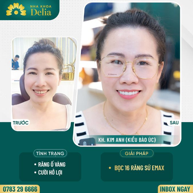 Customer Kim Anh got porcelain teeth at Delia dental clinic