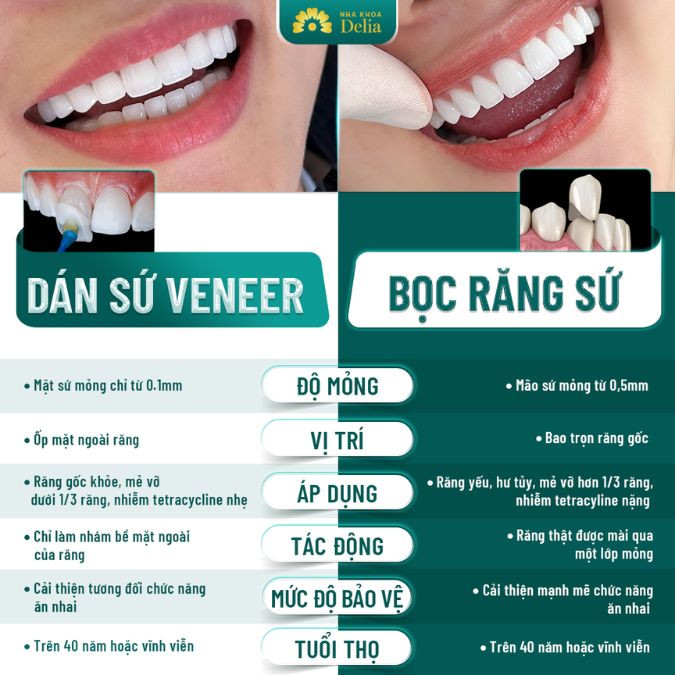 Porcelain crowns versus veneers