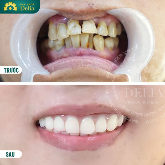 Ảnh hưởng tới tính thẩm mỹ của răng và khuôn mặt