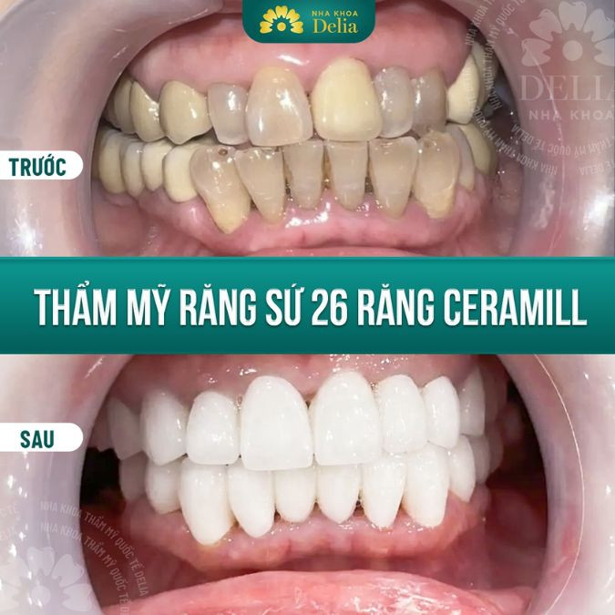 Răng cửa mọc lệch hàm trên