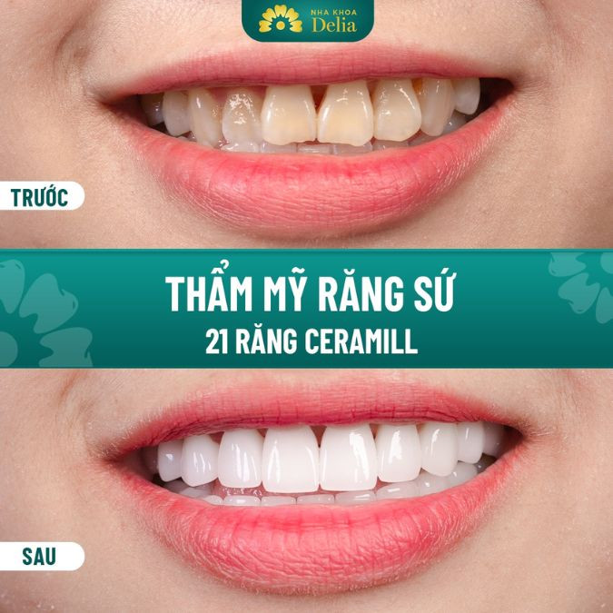 Bọc răng sứ - Cách xử lý răng cửa mọc lệch hiệu quả 