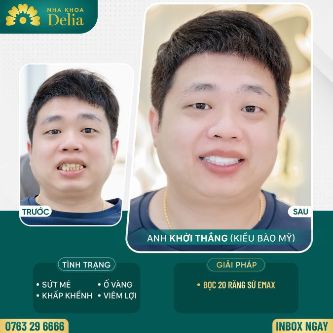 Bọc răng sứ cho răng to và dài