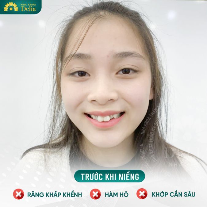 Tình trạng răng vĩnh viễn mọc lệch ra ngoài xảy ra có thể là do bẩm sinh