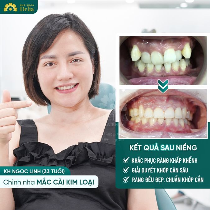 Niềng răng chỉnh nha - Răng hàm mọc lệch nặng