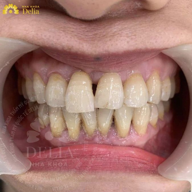 Răng quá nhỏ khiến hở kẽ răng thưa