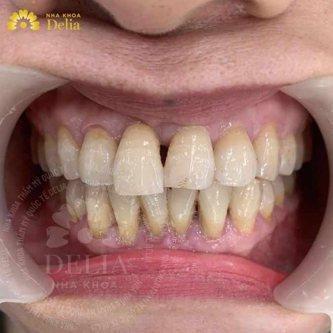 Hình ảnh răng mọc lệch do di truyền 