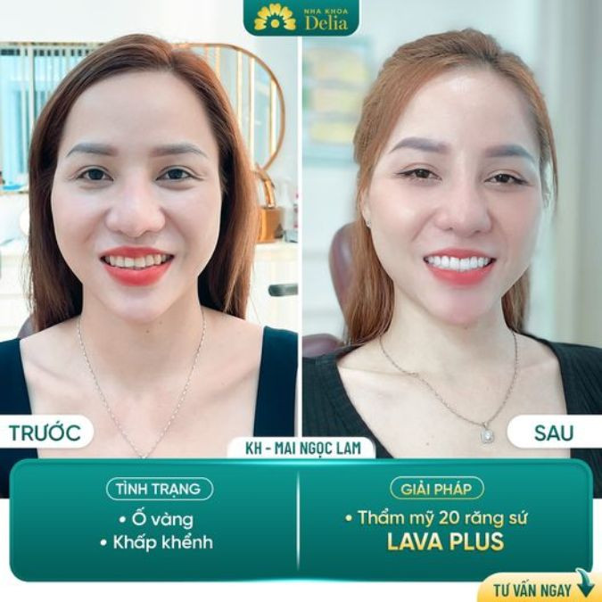 Delia - Địa chỉ bọc sứ và niềng răng tốt nhất Việt Nam 