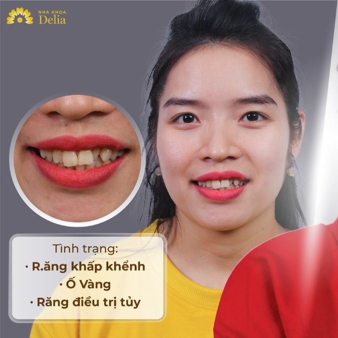 Răng khểnh cũng khiến người đó dễ mắc phải những bệnh lý như viêm lợi, viêm tủy, sâu, viêm nha chu,...