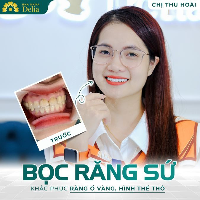 Bọc răng sứ cho răng khểnh