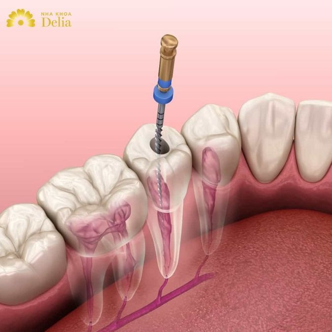 Răng lấy tủy có bị tiêu xương không? 