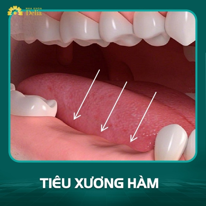 Răng lấy tủy bị mất răng tiêu xương phải làm sao? 