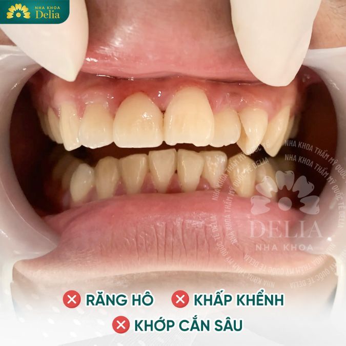 Răng quá nhỏ hoặc răng quá lớn so với hàm khiến răng mọc lệch