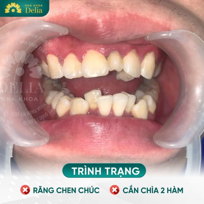 Ở nhiều người những xương răng bẩm sinh đã không được sắp xếp đúng vị trí khiến cho răng mọc lệch