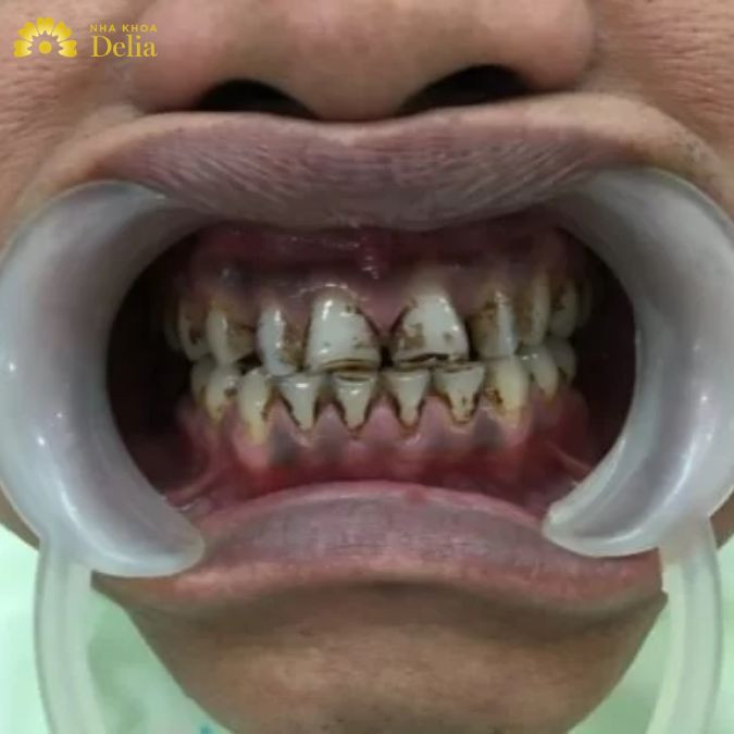 Răng đen men răng suy yếu