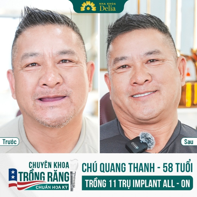 Biện pháp khắc phục và ngăn chặn tiêu xương hàm hiệu quả