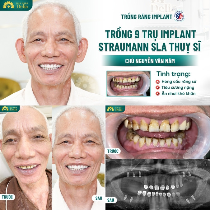 Tiêu xương hàm có trồng răng được không?